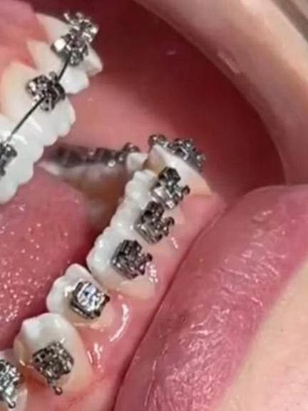 正畸 钢丝 移位-图2 正畸 钢丝 移位-图2