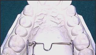 铸造TPA 正畸-图1 铸造TPA 正畸-图1