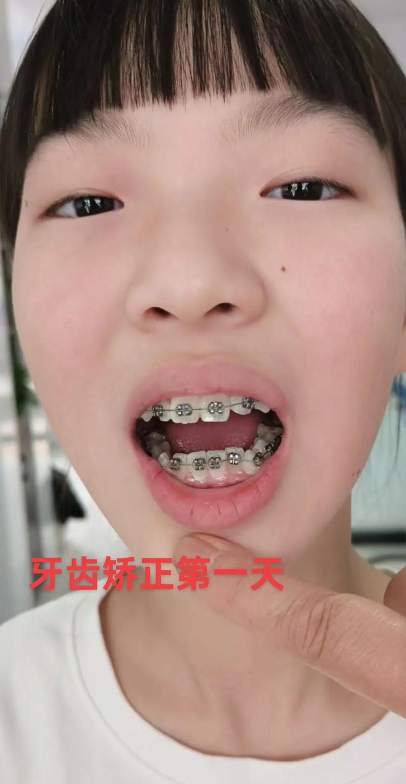 2025暑期正畸如何高效进行？时间安排与效果如何兼顾？-图1