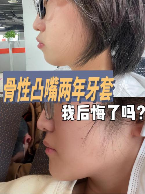 骨性值不值得正畸-图1