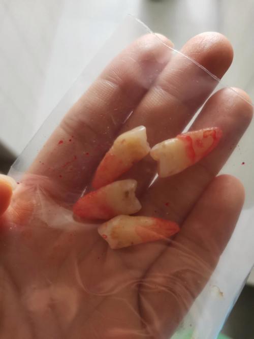 正畸拔五号牙内收-图1