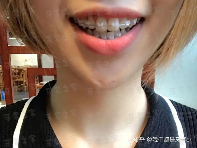 正畸拔五号牙内收-图2