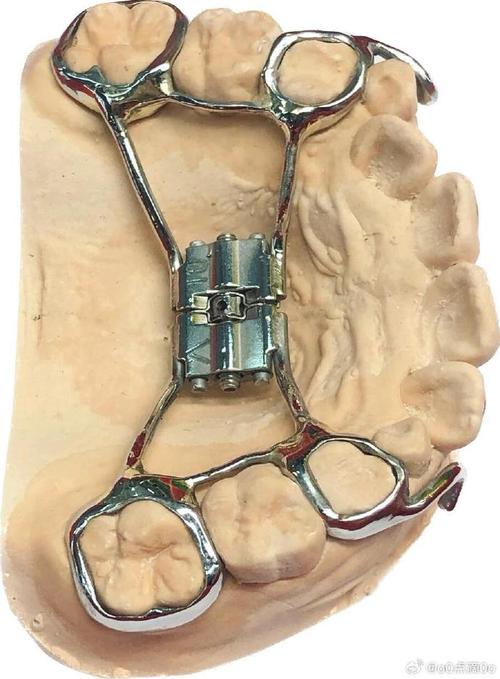 正畸前方牵引器图-图3