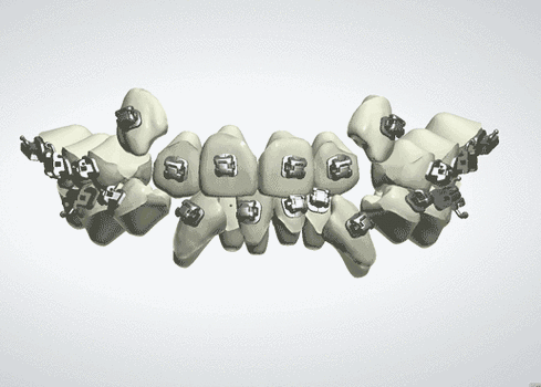 数字化正畸是什么-图2