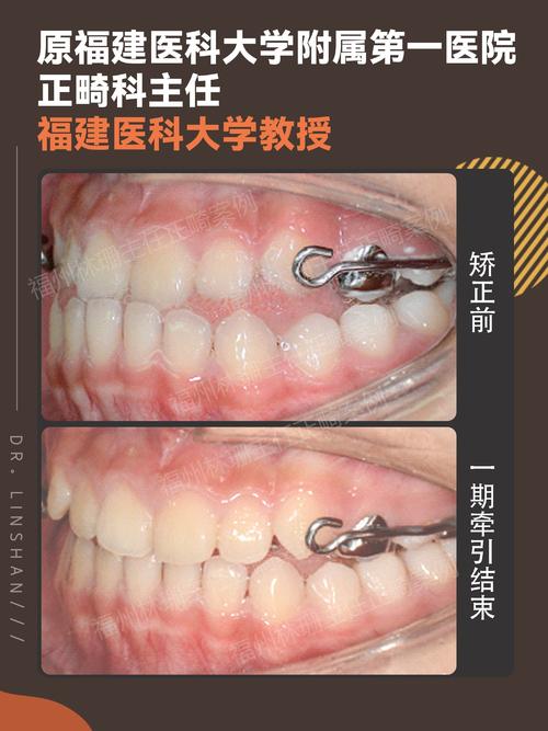 口腔正畸中的高角-图1