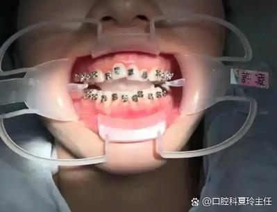 儿童牙齿正畸疼吗-图3