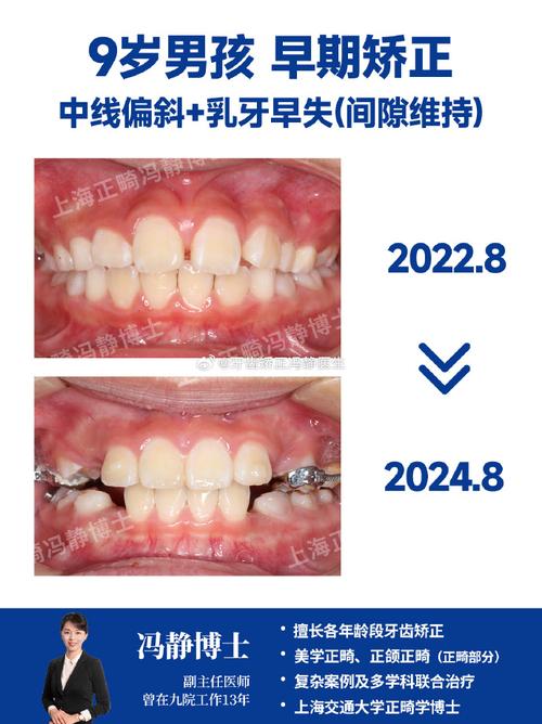 正畸可以对中线吗-图2