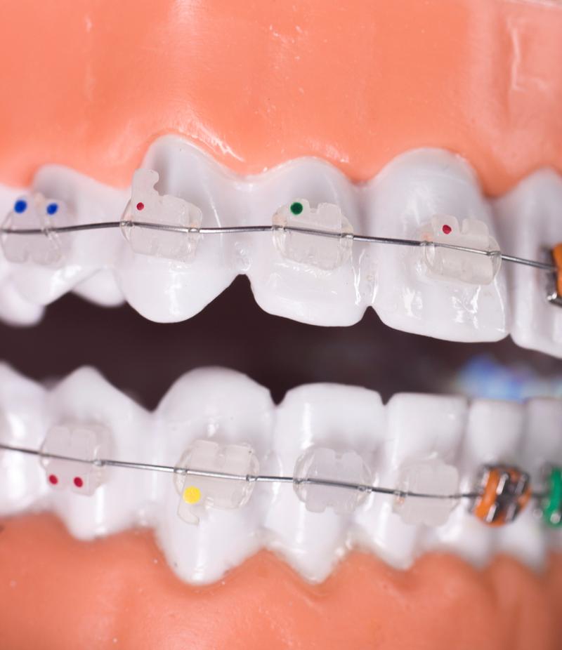 正畸托槽上下左右-图3