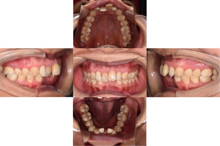 牙周病患者正畸，联合治疗如何兼顾健康与美观？-图2