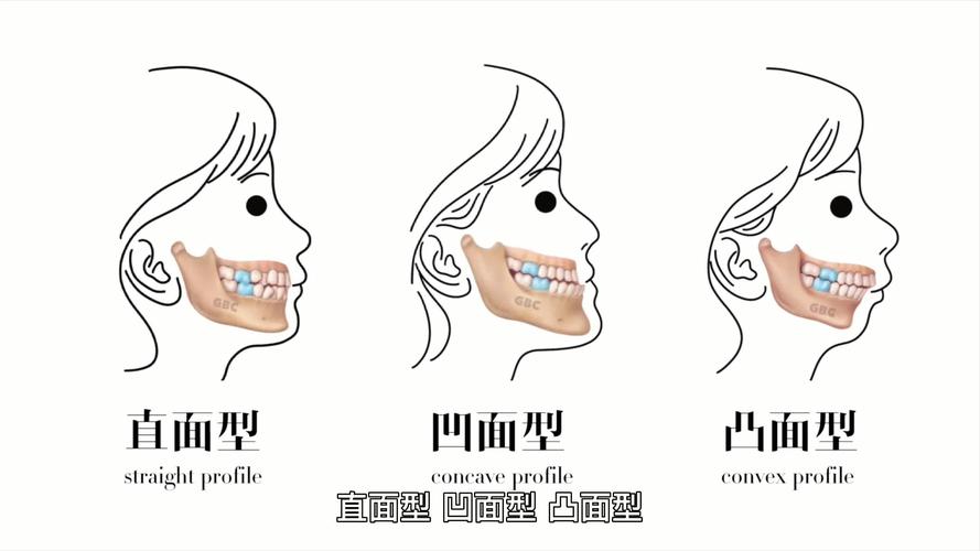 正畸中的面型分类-图2