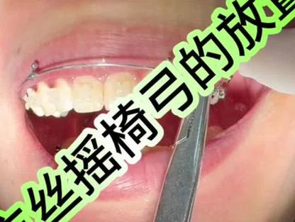 正畸摇椅弓怎么弯？关键步骤与实用技巧详解-图1