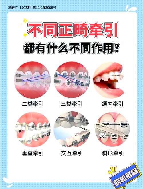 正畸牵引牙齿疼吗-图2