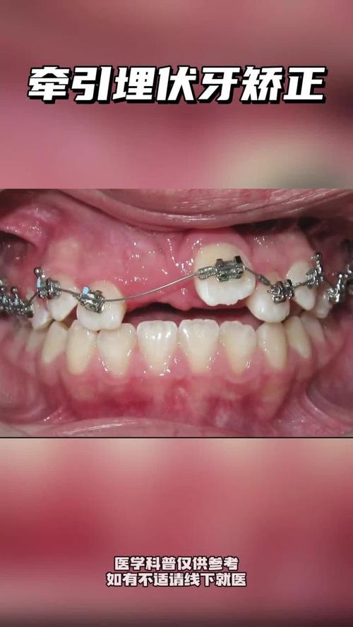 正畸牵引牙齿疼吗-图3