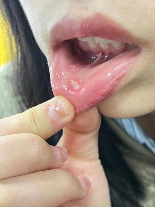正畸初期口腔溃疡-图2