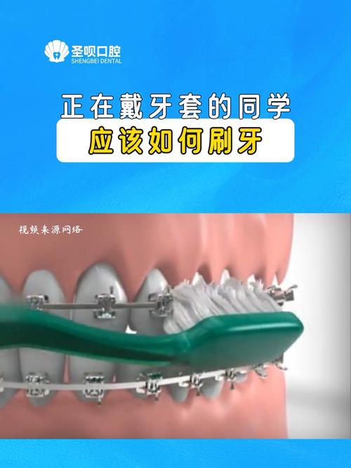 正畸刷牙有哪些注意事项?-图3 正畸刷牙有哪些注意事项?-图3