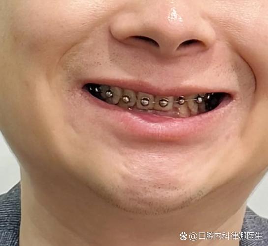 临时冠可以正畸吗-图1