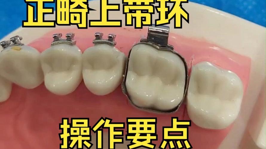 口腔正畸带环方向如何精准把控？影响矫治效果的关键因素？-图1