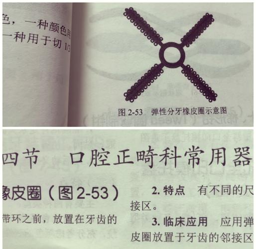 口腔正畸带环方向如何精准把控？影响矫治效果的关键因素？-图2