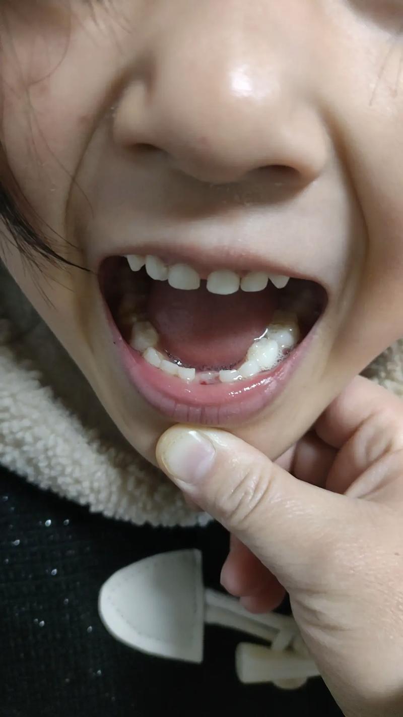 正畸导致牙齿脱落，原因究竟出在哪？-图2