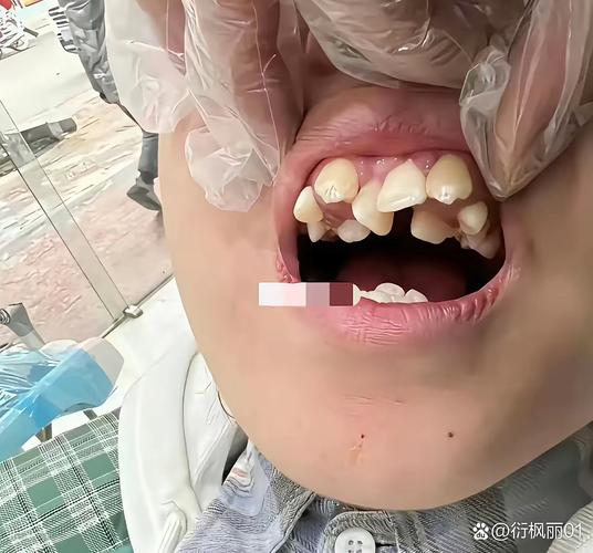 正畸期间晚上咬牙-图1