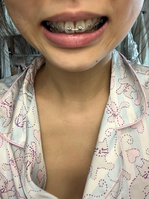 正畸期间晚上咬牙-图2