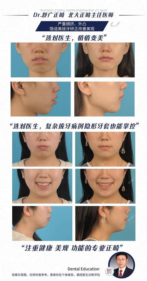 正畸拔牙影响脸型-图3