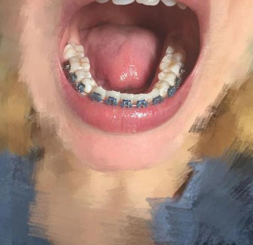 正畸橡皮链为什么会染色？会影响矫正效果吗？-图3