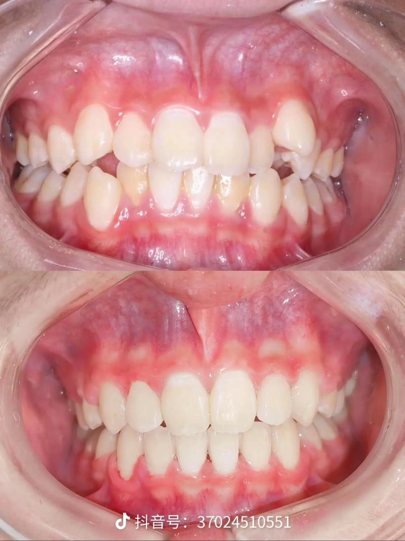 西京医院口腔正畸效果如何?优势有哪些?-图3 西京医院口腔正畸效果如何?优势有哪些?-图3