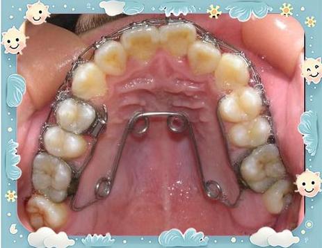 正畸四眼圈簧图片具体展示什么？-图1