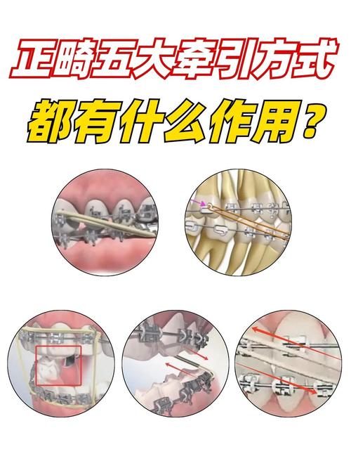 正畸二类牵引的作用机制与效果是什么？-图2