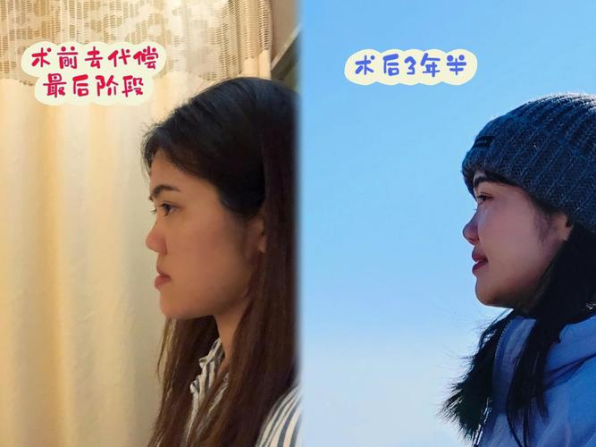 30岁正畸后遗症-图2