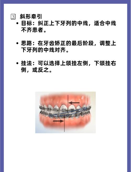 正畸治疗时橡皮筋每天需要佩戴多久?-图1 正畸治疗时橡皮筋每天需要佩戴多久?-图1