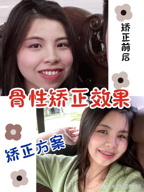 骨性正畸效果究竟如何？真实疗效深度解析-图2