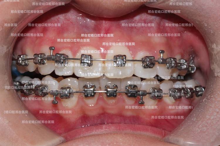 骨性正畸效果究竟如何？真实疗效深度解析-图3