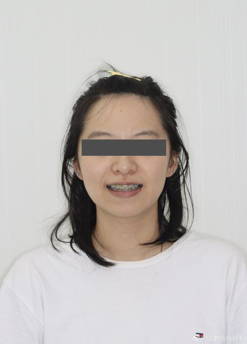 正畸 第一双尖牙-图3