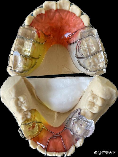 正畸下颌颌垫制作的关键步骤与注意事项有哪些？-图2