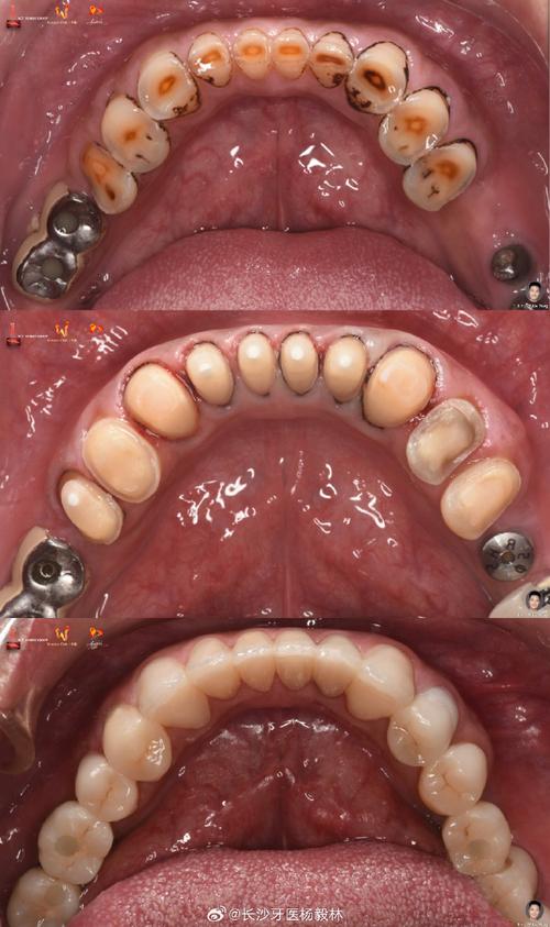 牙齿正畸为何需外科手术？效果与风险如何？-图1