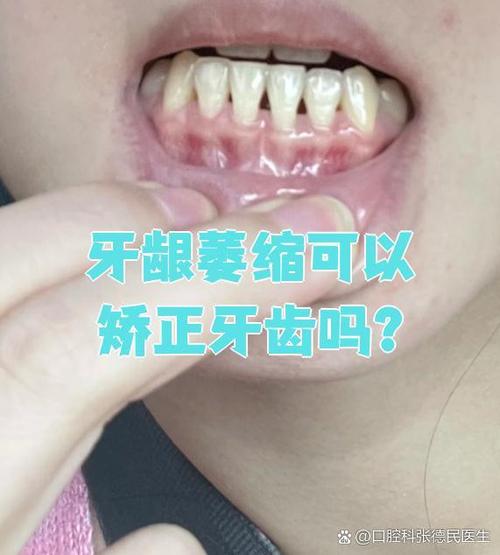 正畸会牙龈萎缩吗-图2
