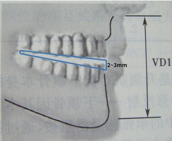 正畸牙弓长度测量-图1