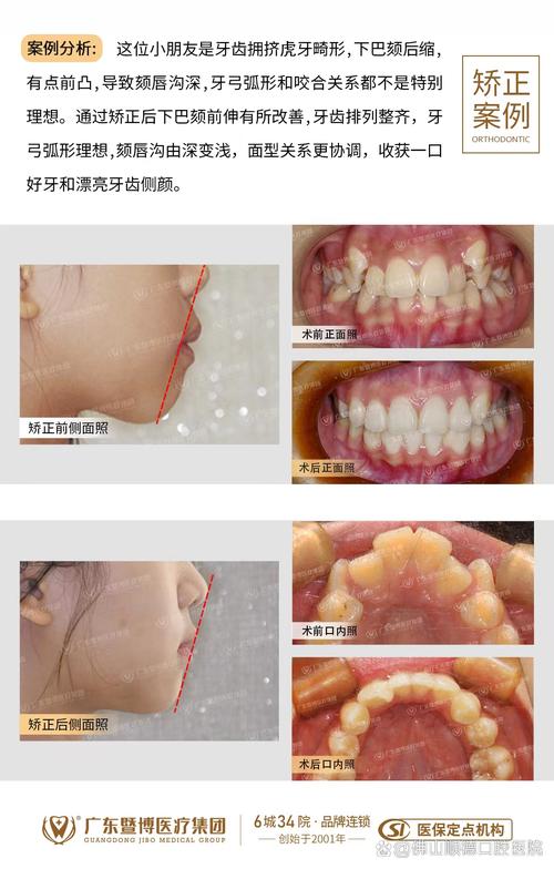 牙齿稀疏正畸案例-图2