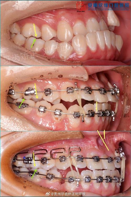最新牙齿正畸手术-图1 最新牙齿正畸手术-图1