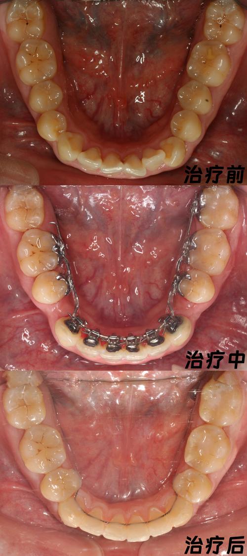最新牙齿正畸手术-图2 最新牙齿正畸手术-图2