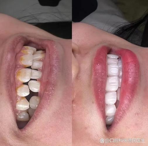 正畸期间牙缝变大-图2