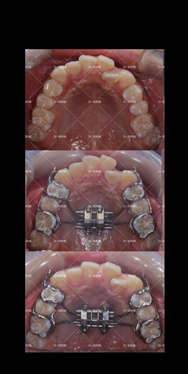 正畸mbt弓形图-图2 正畸mbt弓形图-图2