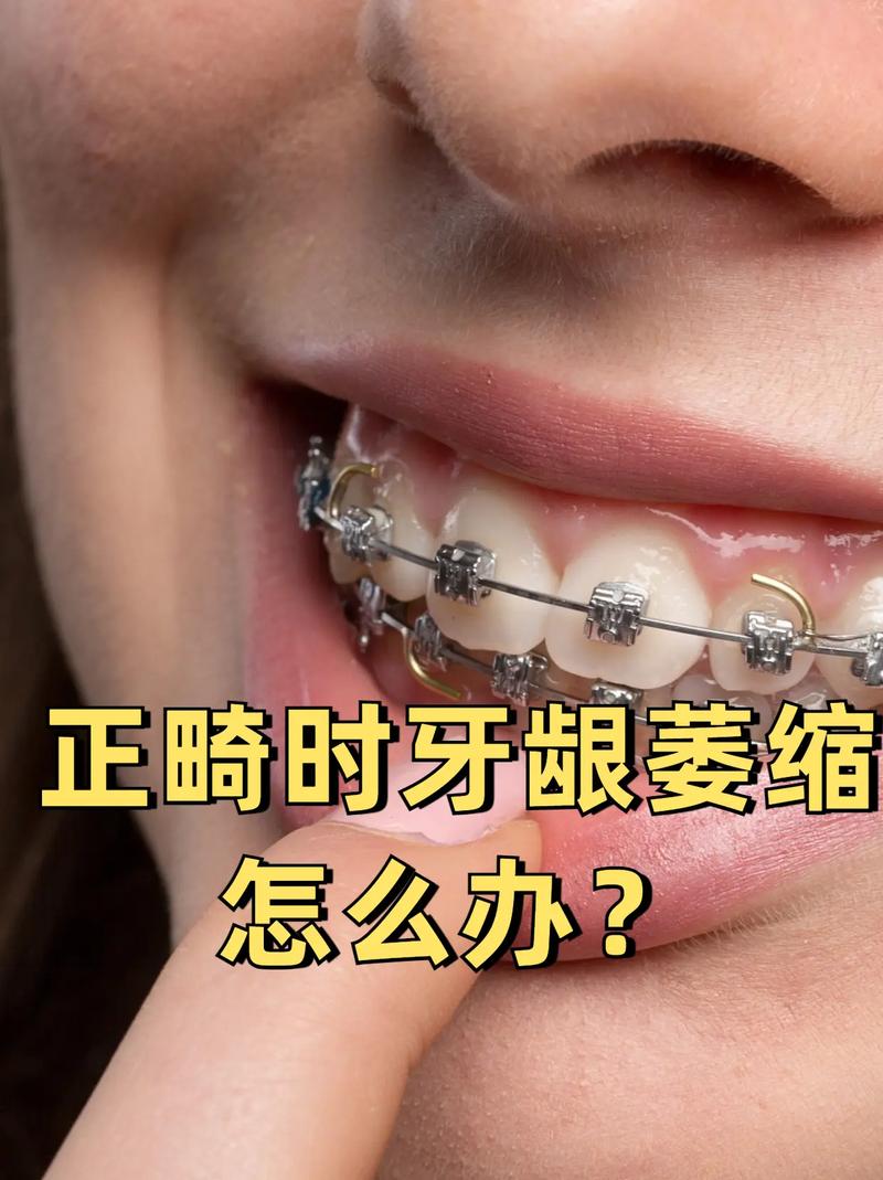 牙龈萎缩能正畸吗-图1