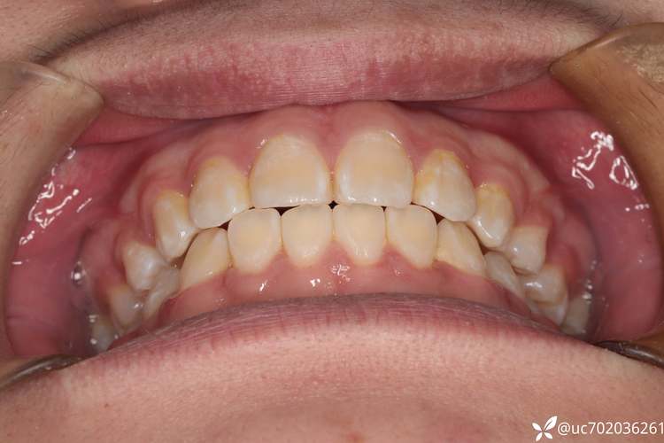 正畸拔牙会导致颧骨变高吗？-图1