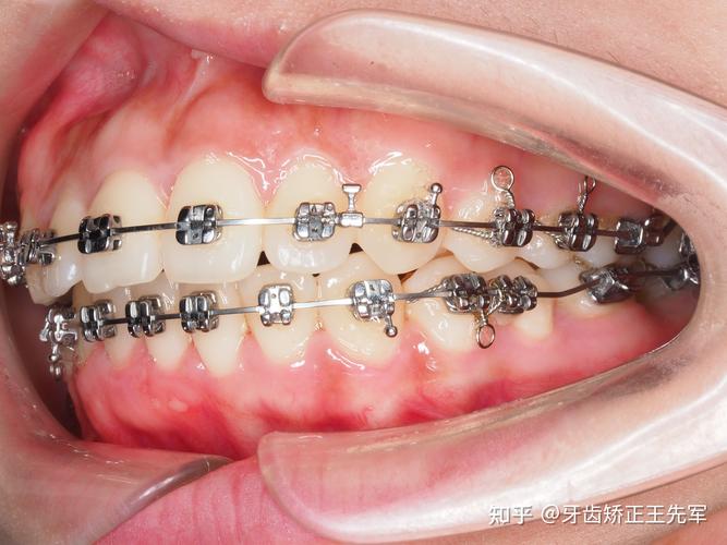 自锁托槽正畸技术-图2