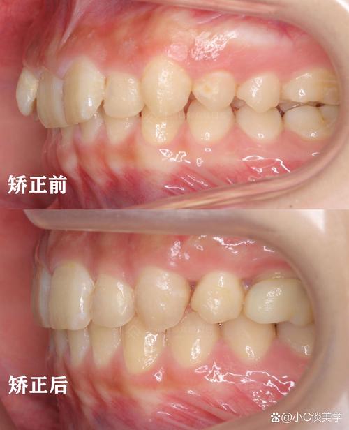 前牙深覆盖 正畸-图1 前牙深覆盖 正畸-图1