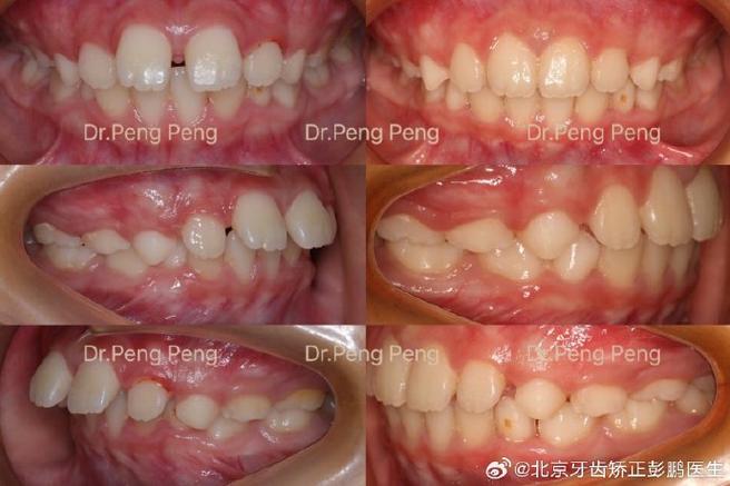 前牙深覆盖 正畸-图2 前牙深覆盖 正畸-图2