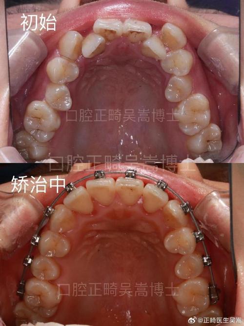 龅牙不拔牙正畸可行吗？效果怎么样？-图1